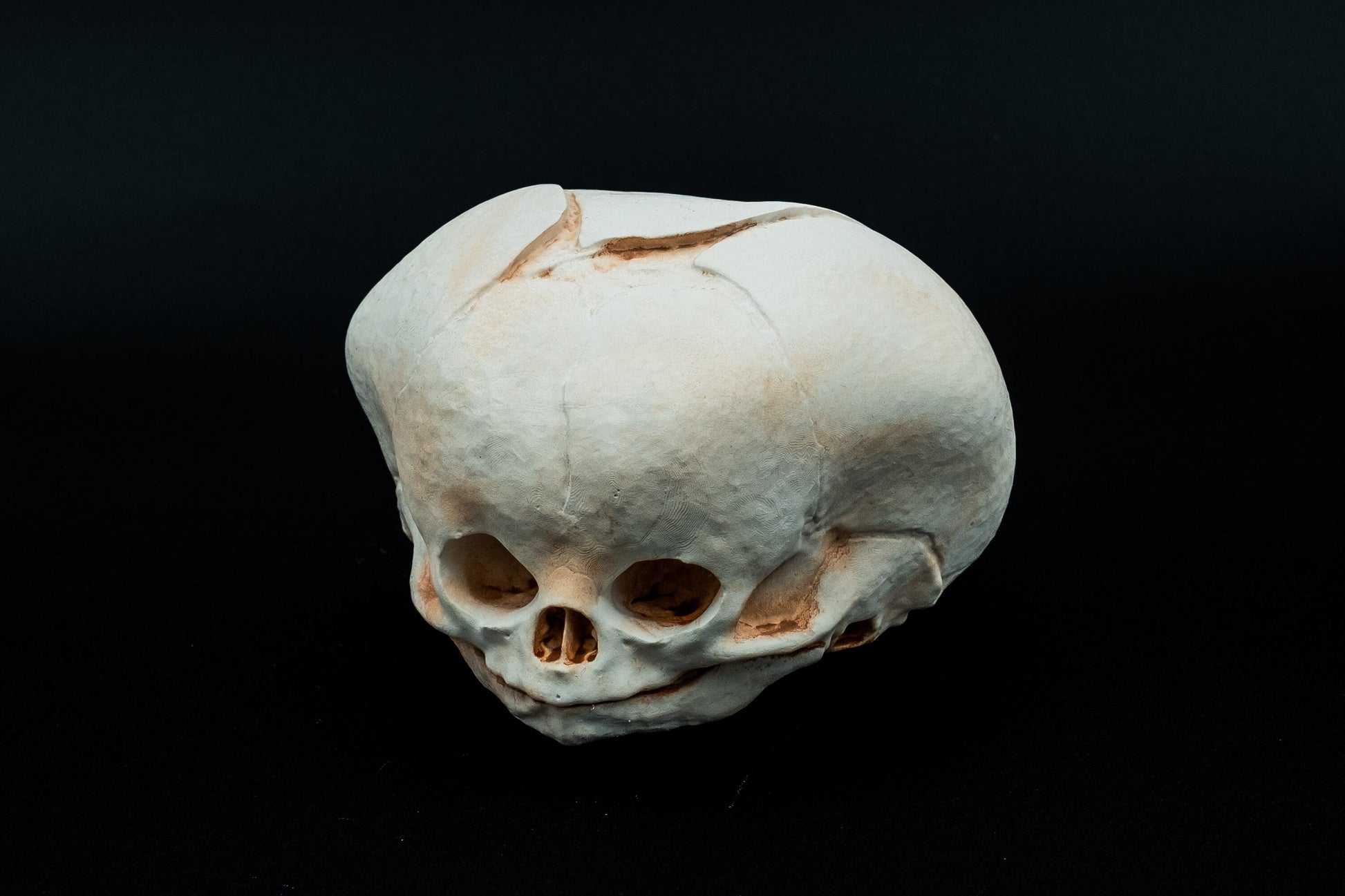 Conjoined Twin Fetal Skull Replica Craniopagus Twinning - Safety Third Studios