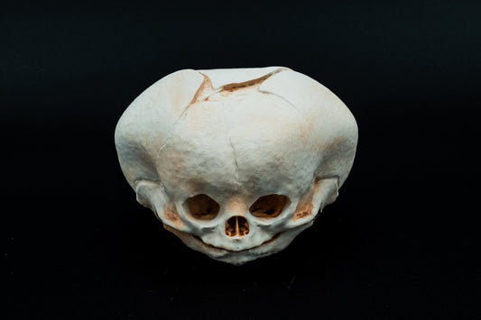 Conjoined Twin Fetal Skull Replica Craniopagus Twinning - Safety Third Studios